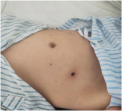 Case report: A case of sepsis caused by rickettsial infection-induced hemophagocytic syndrome